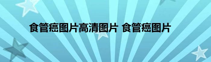 食管癌图片高清图片 食管癌图片